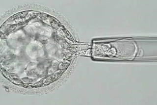 Imagen que muestra la técnica de la biopsia de un embrión durante un ciclo de FIV para el análisis de PGT-A. Se puede ver un embrión en una placa de Petri, una pipeta de micromanipulación y un microscopio utilizado para la realización de la biopsia.